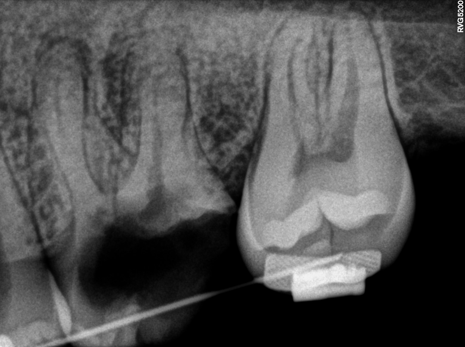 Dental X-ray